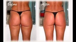 cellulite treatment