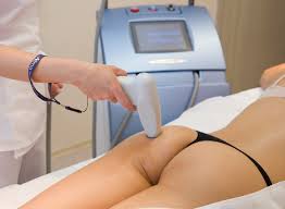 Cellulite laser removal