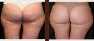 best cellulite removal